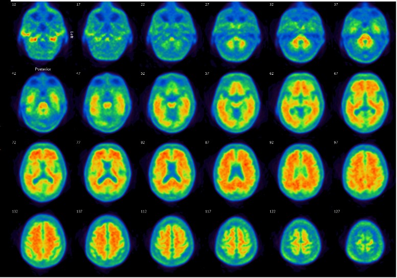 PET-amiloide cerebral de un paciente con Alzheimer