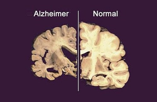 Qué es la enfermedad de Alzheimer